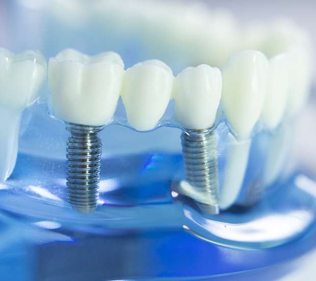 LaGrange Dental Implants